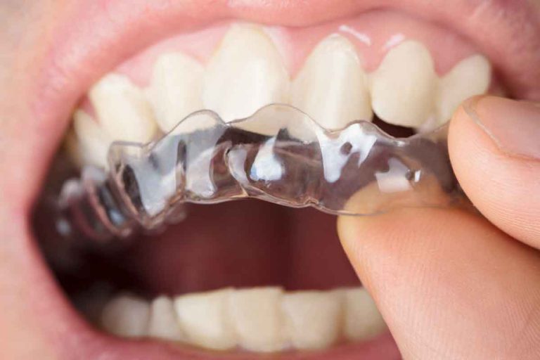 Crooked Teeth We Can Help You 768x512