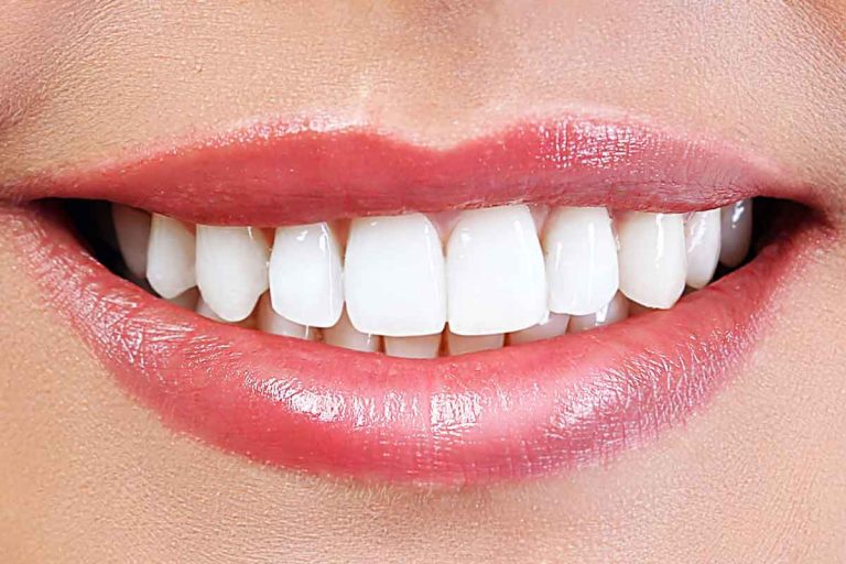 Teeth Whitening – An Incredible Look 768x512
