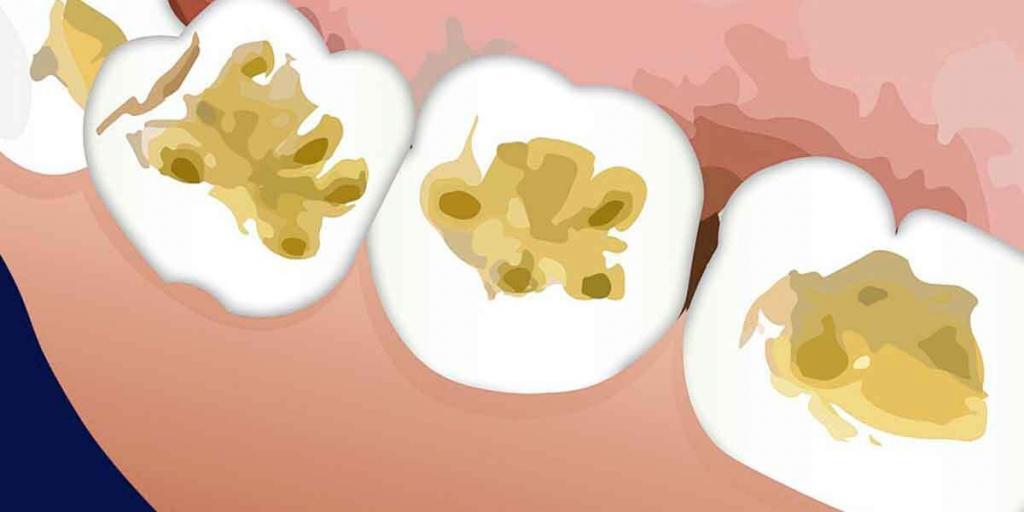 Common Restorative Dental Procedures Performed In Dental Offices