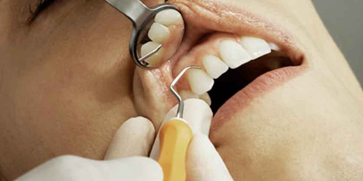 Dental Implants vs. Dental Bridges - A Comprehensive Guide