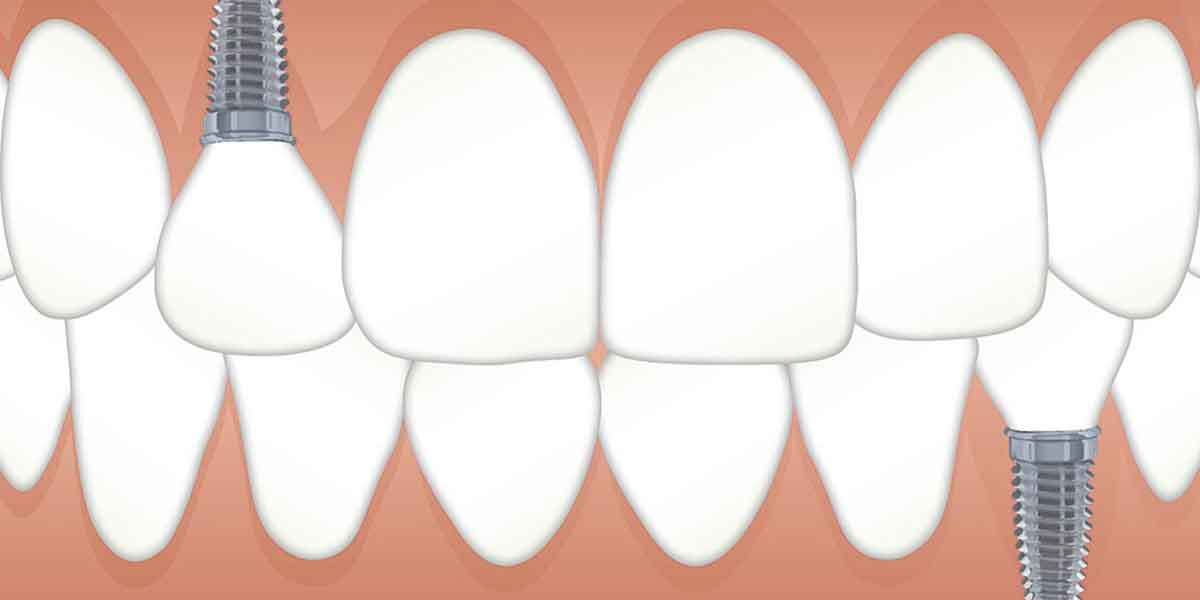 Dental Implants – Procedure And Benefits