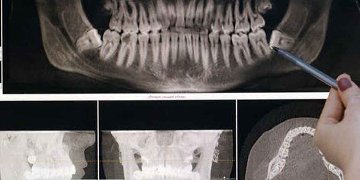 Different Types of Dental X-Rays Performed and Role of The Dentist