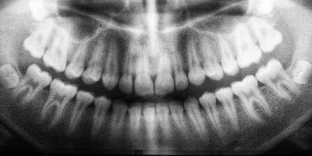 Top Reasons to Straighten Your Teeth: Lifelong Better Oral Care