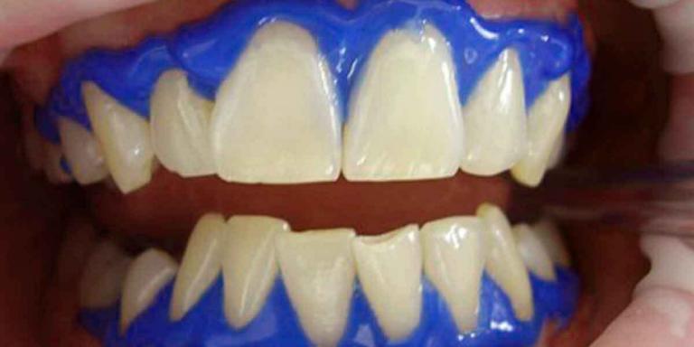 Find A Dentist Near Me For The Right Teeth Whitening Procedure