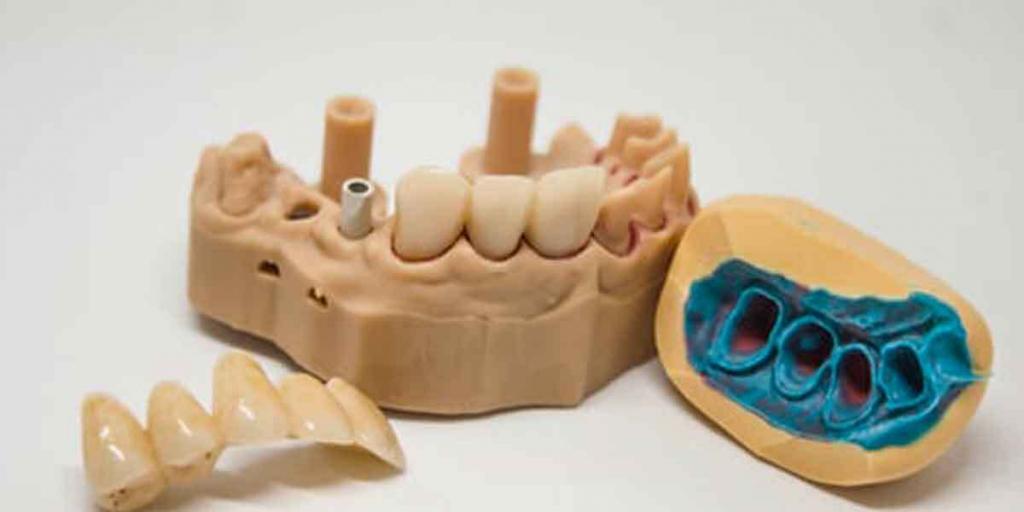 Understand All About Onlay & Inlay By Most Recommended Dentist Near Me