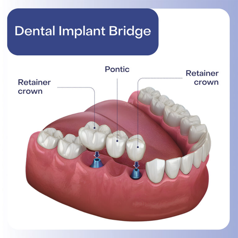 dental implant bridge 768x768