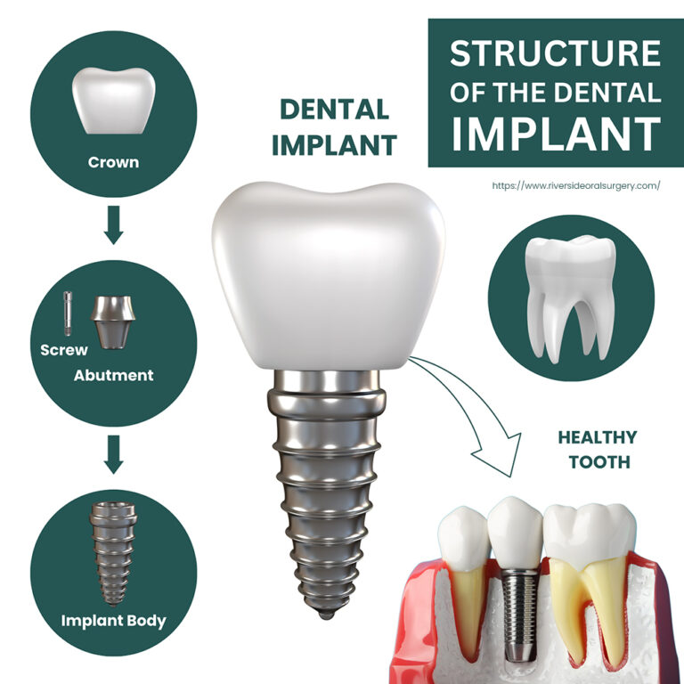 dental implant structure 768x768