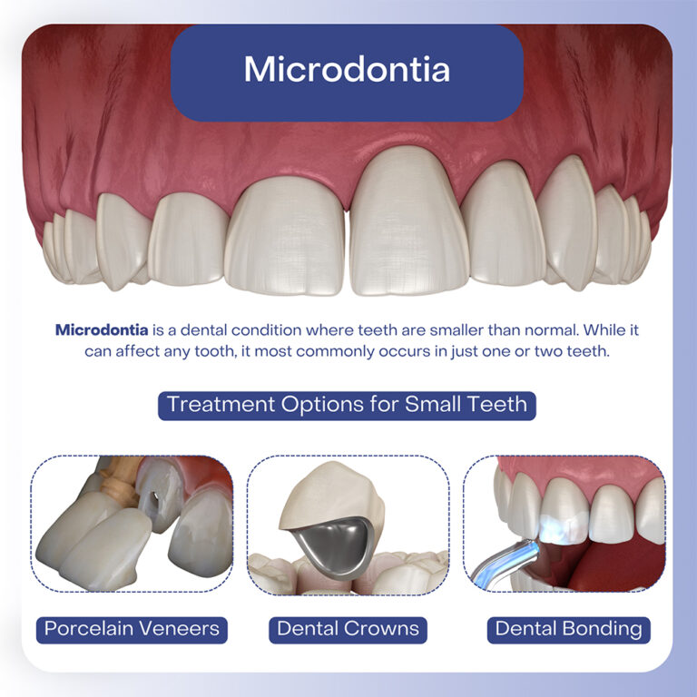 small teeth microdontia 768x768