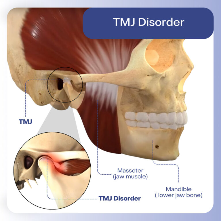 tmj disorder 768x768