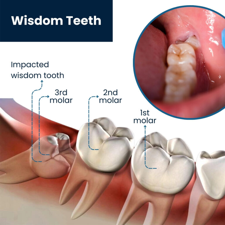 wisdom teeth 768x768