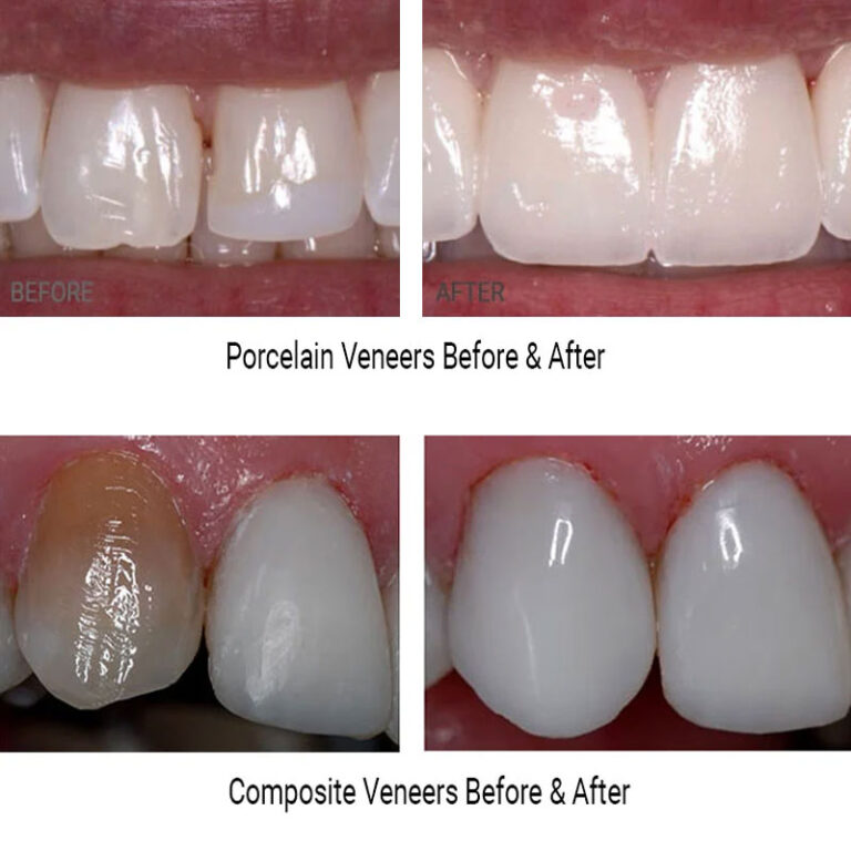 Dental Veneers NYC Before After 768x768