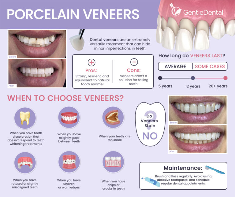 Porcelain Veneers 768x644