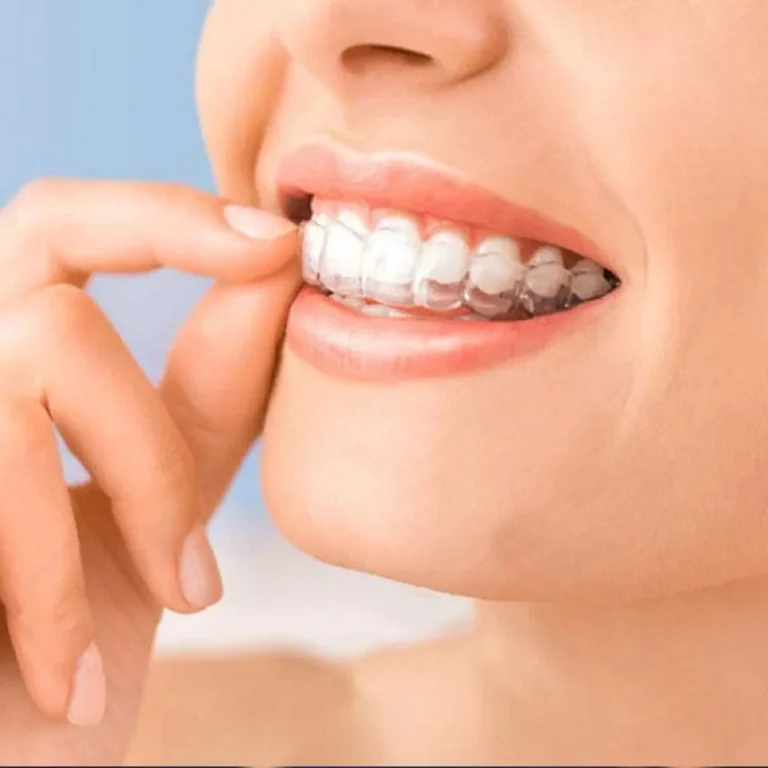 INVISALIGN 1 768x768