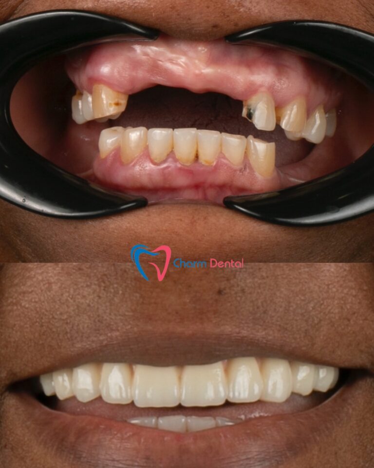 Dental Implants in Humble TX