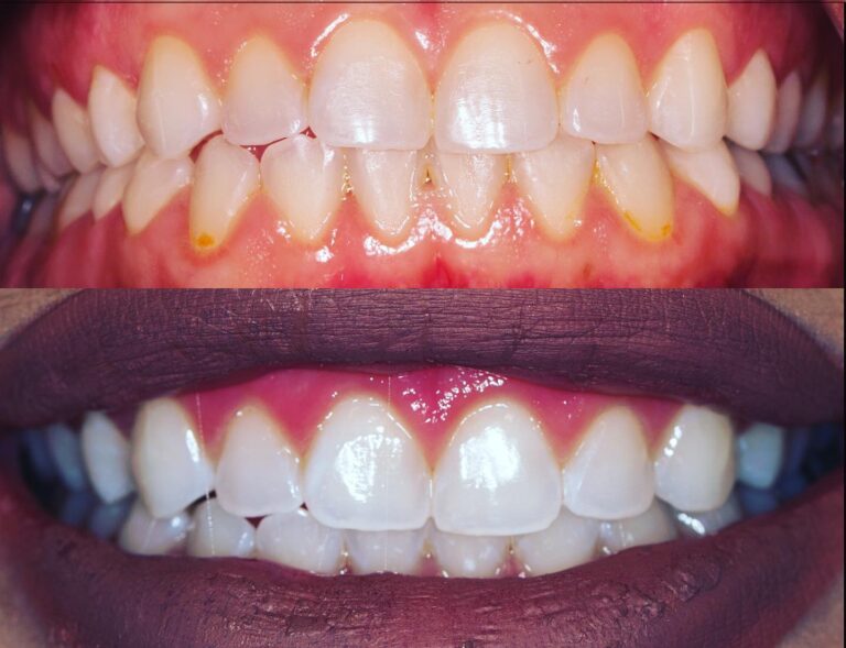 Teeth Whitening by Charm Dental Katy 768x589