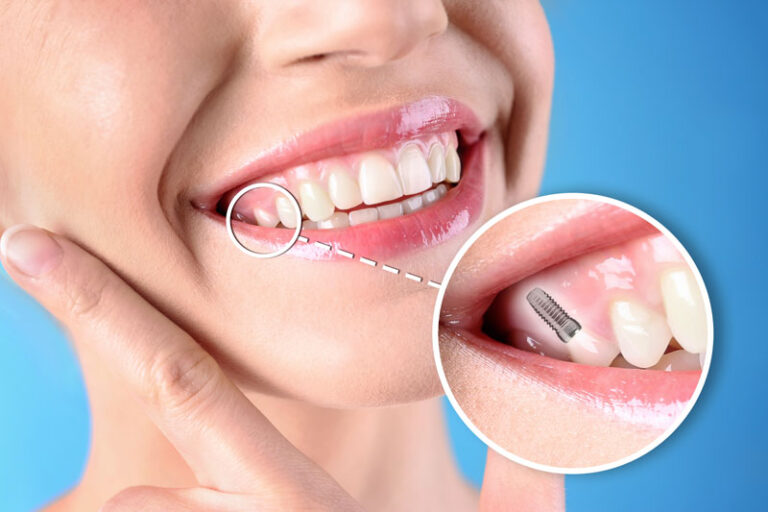 Dental Implants 768x512