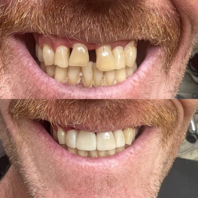 star dental dental bonding tooth gap before after denver 768x768
